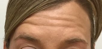 Xeomin results in Leominster Before