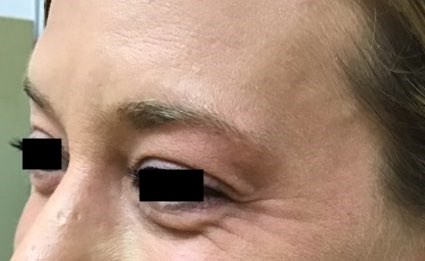 Eliminate Crows Feet w/ Xeomin Before