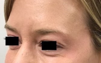 Eliminate Crows Feet w/ Xeomin After
