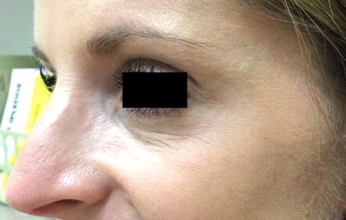 Left Periorbital Crow's Feet After