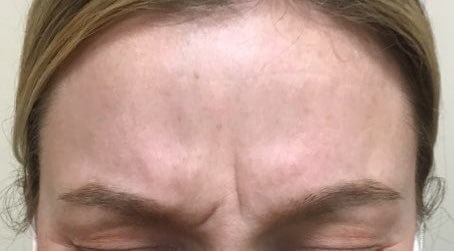 Zero "11's" after Botox Before