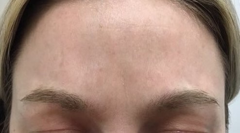 Zero "11's" after Botox After