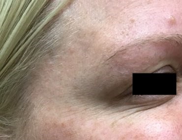 Right side, before and after After