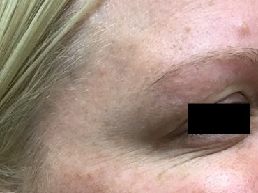 Right side, before and after After